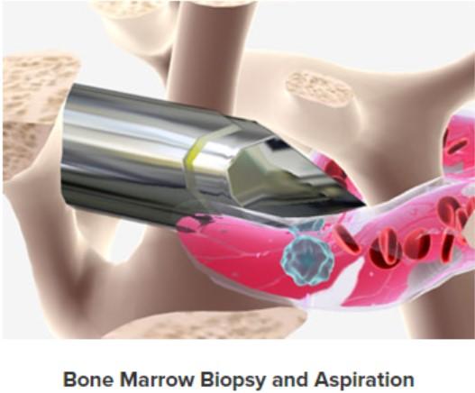 bone_marrow_biopsy